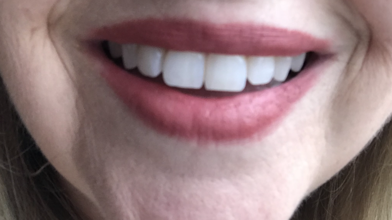 After whitening with Smile Brilliant.
